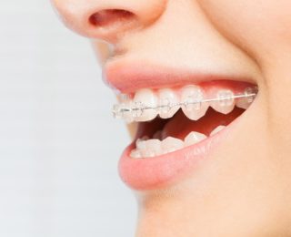 L’orthodontie pour adultes