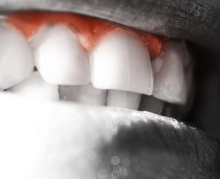 Qu’est ce que la parodontite ?